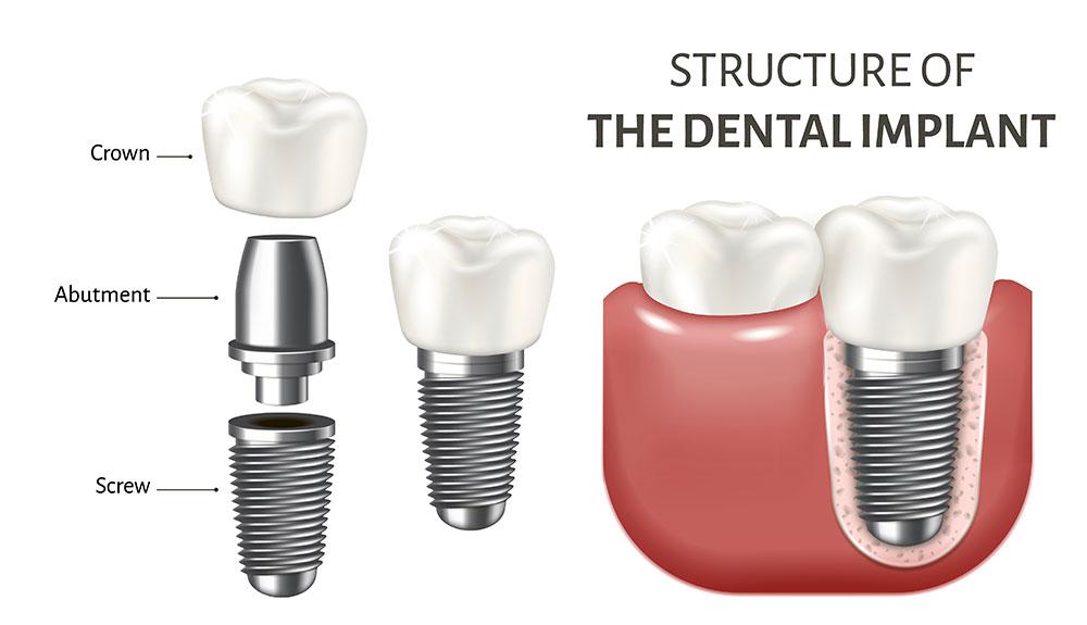 Infographic of dental implant and prosthetic tooth